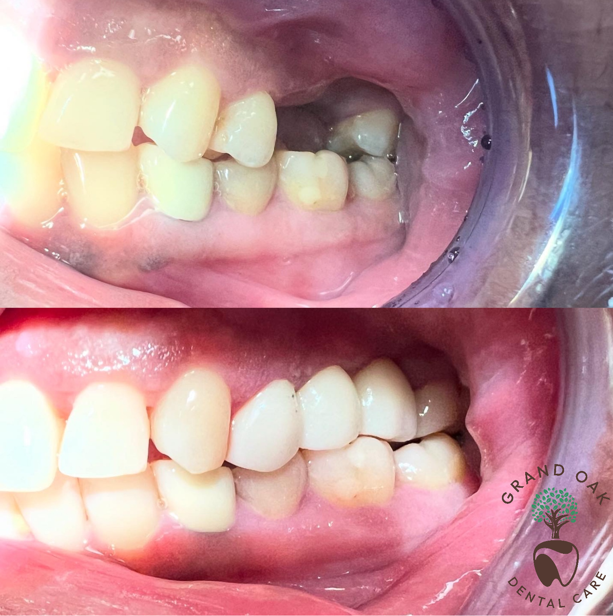 Multiple Teeth Replaced with Zirconia Bridge Restoration